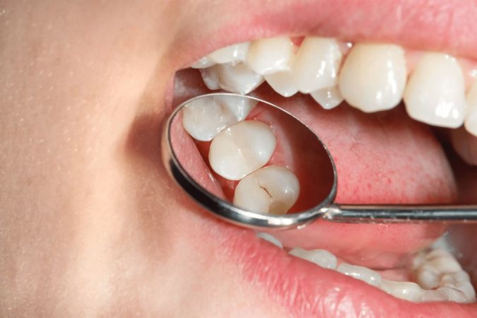 Busqueda de caries en dientes Merca2.es