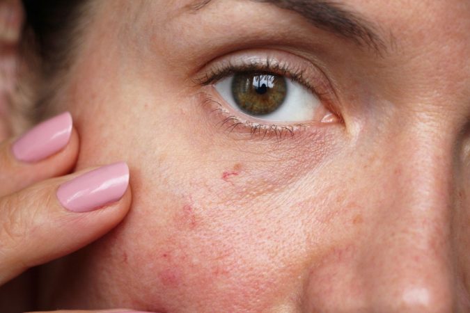 La mizuna cura heridas, marcas y cicatrices