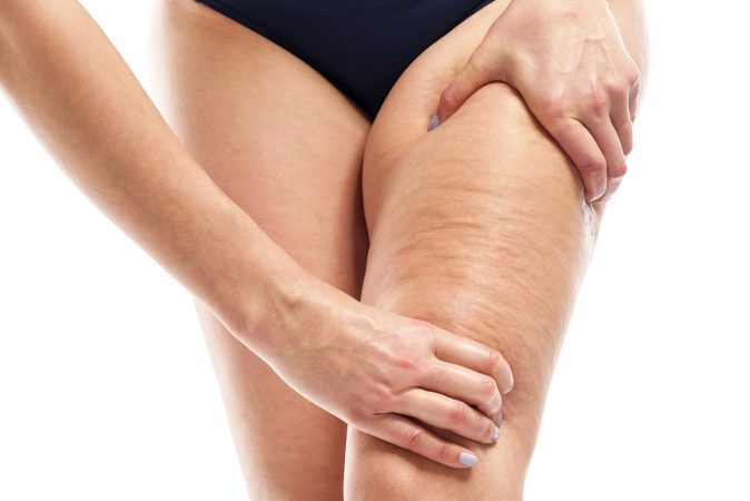 La verdad sobre los productos "milagro" para la celulitis
