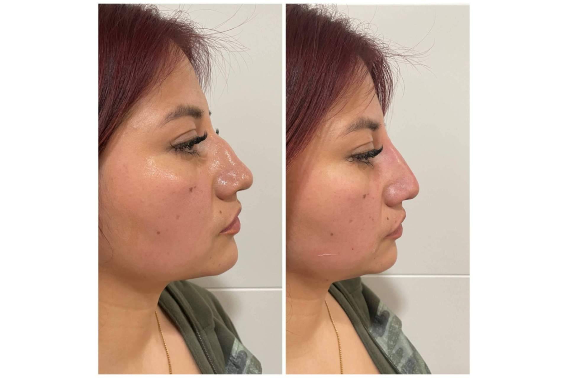 Rinomodelación sin cirugía de forma exitosa en Cecilia Arthur
