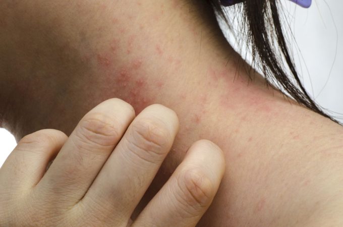 Dermatitis alérgica