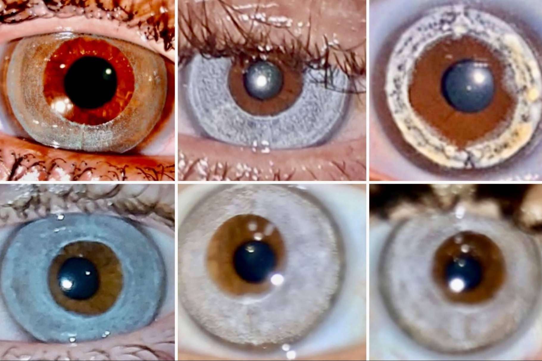 Ventajas del láser NewEyes sobre la queratopigmentación, con Clínica Eyecos