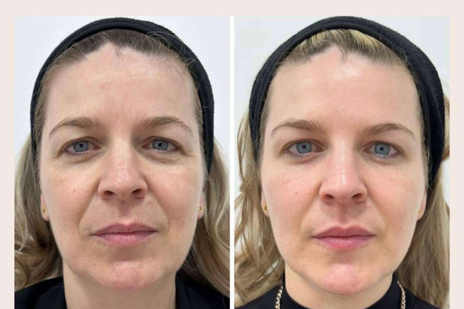 Combatir la flacidez facial, con Clínica VISO