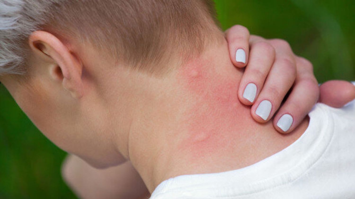 Alergias: 10 formas de controlar los síntomas