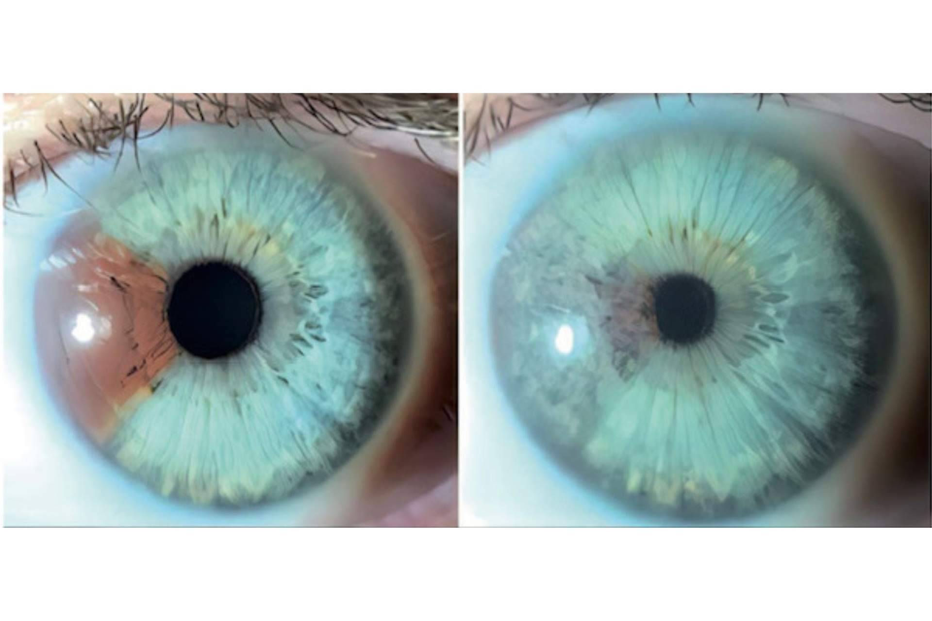 Los heterocromías y los nevus del iris pueden ser tratados con láser según Clínica Eyecos