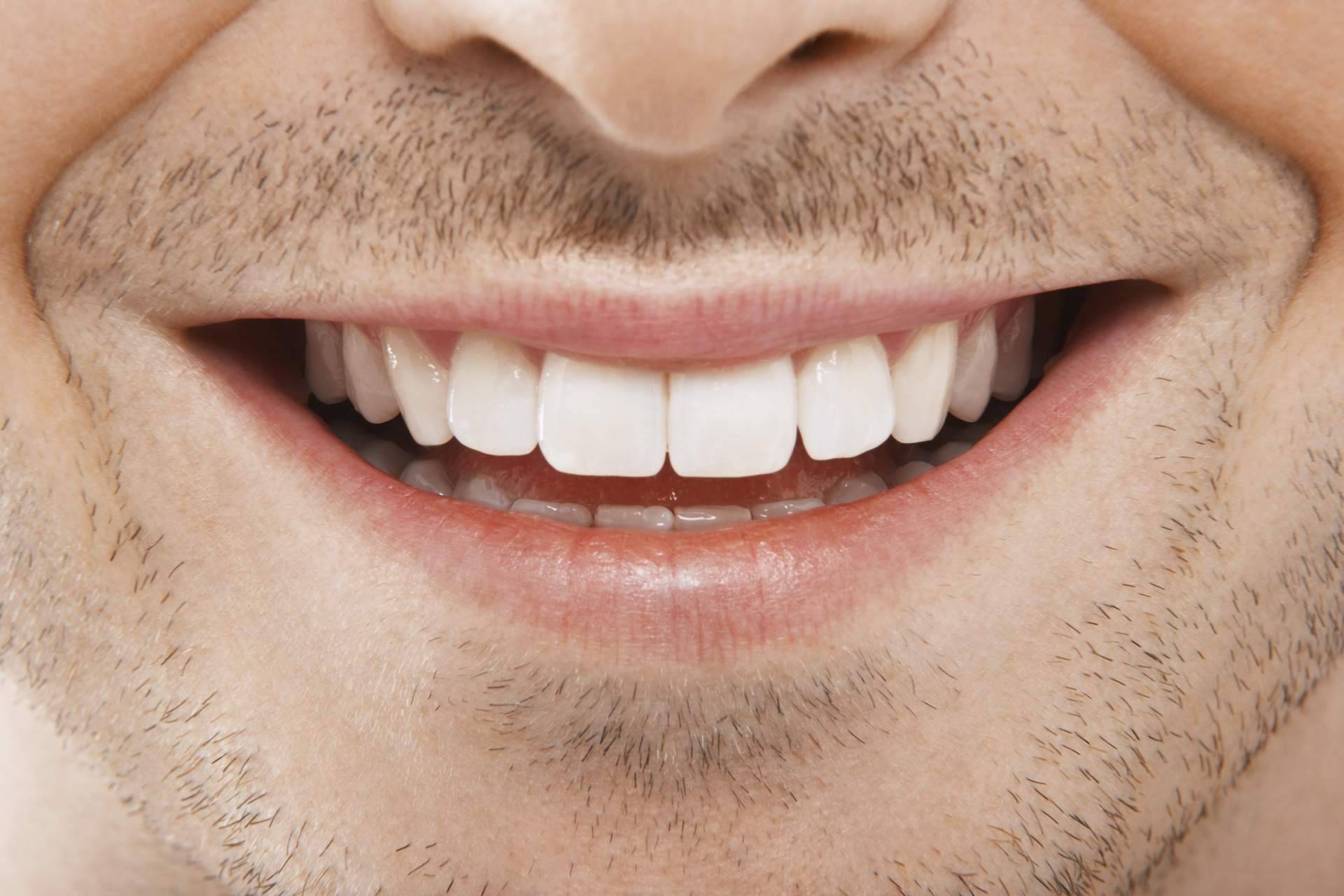 ¿Qué son las carillas de composite?, por Carlos Saiz Smile