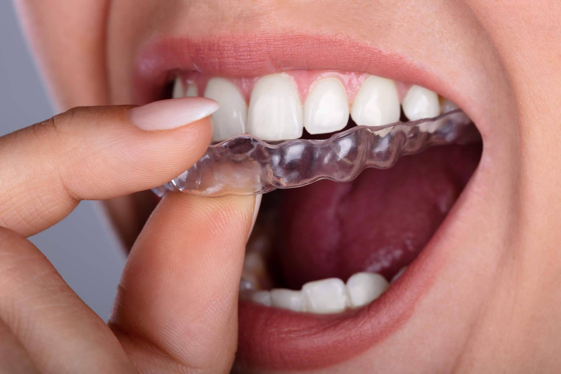 Tratamiento de ortodoncia invisible con los dentistas Alcorcón de Clínica Darío Ulman