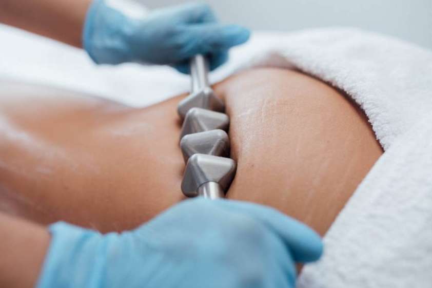 Celulitis, grasa y remodelación de los glúteos