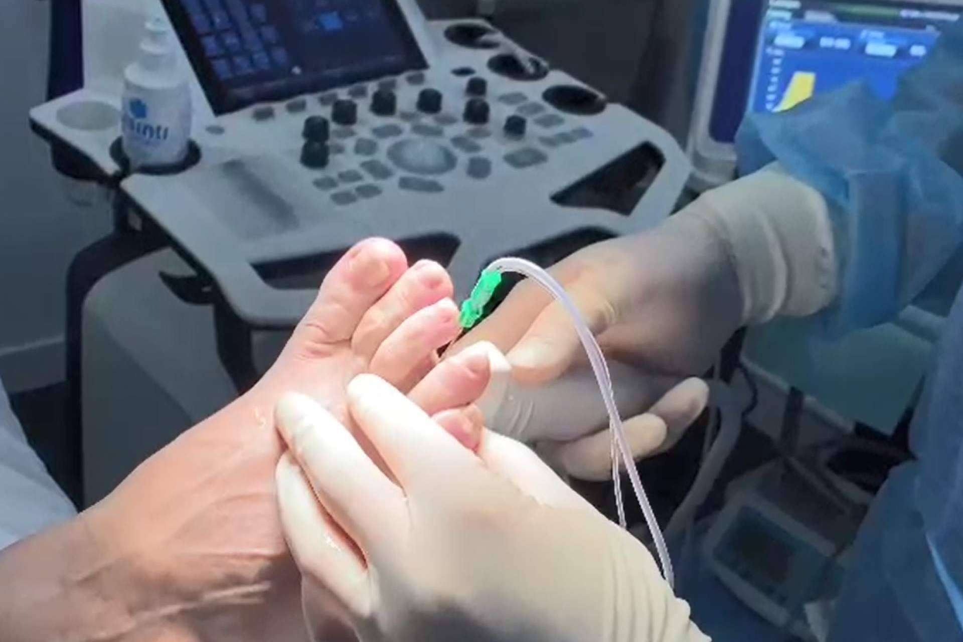 Tratamiento no invasivo y sin suturas para el neuroma de Morton