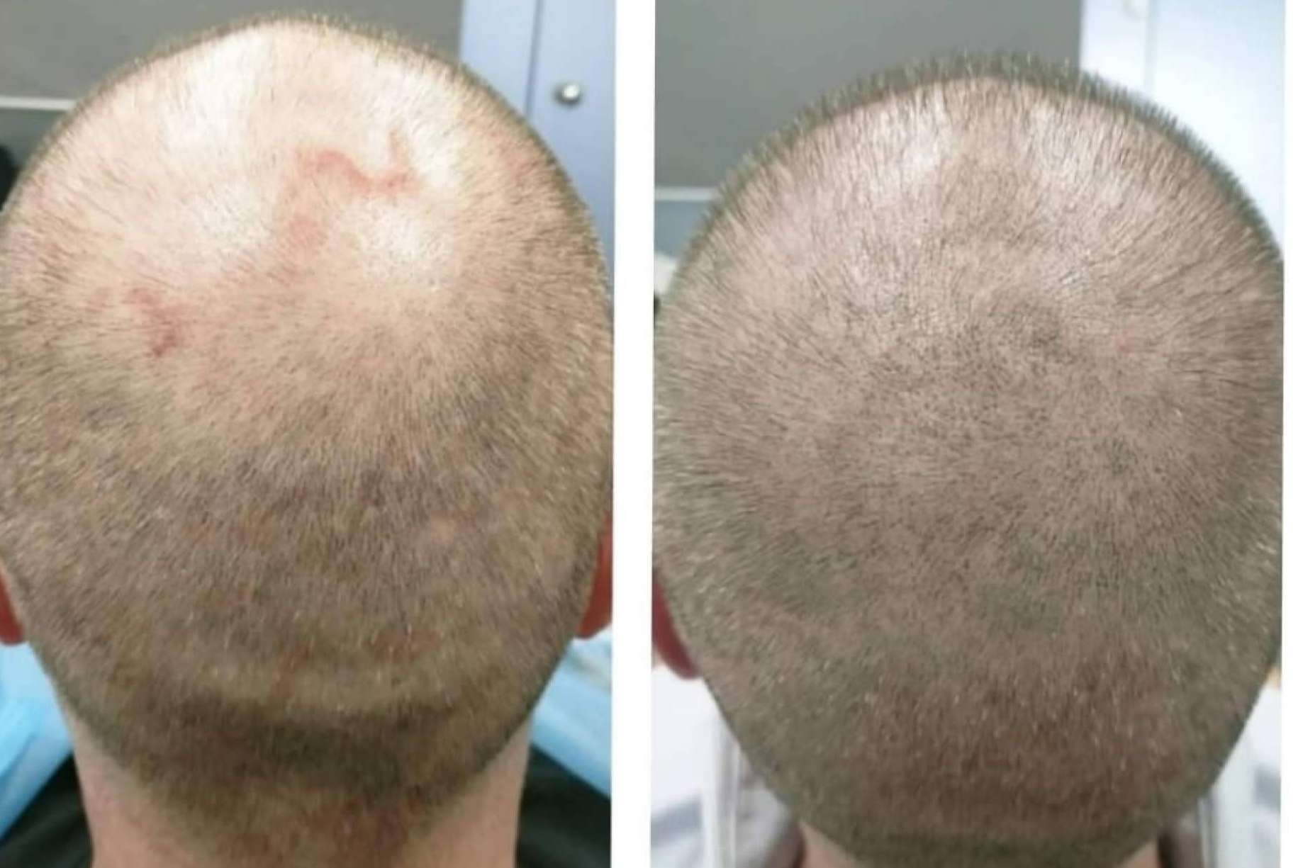 Los beneficios de la micropigmentación capilar, por Dermopigmentación Clínica