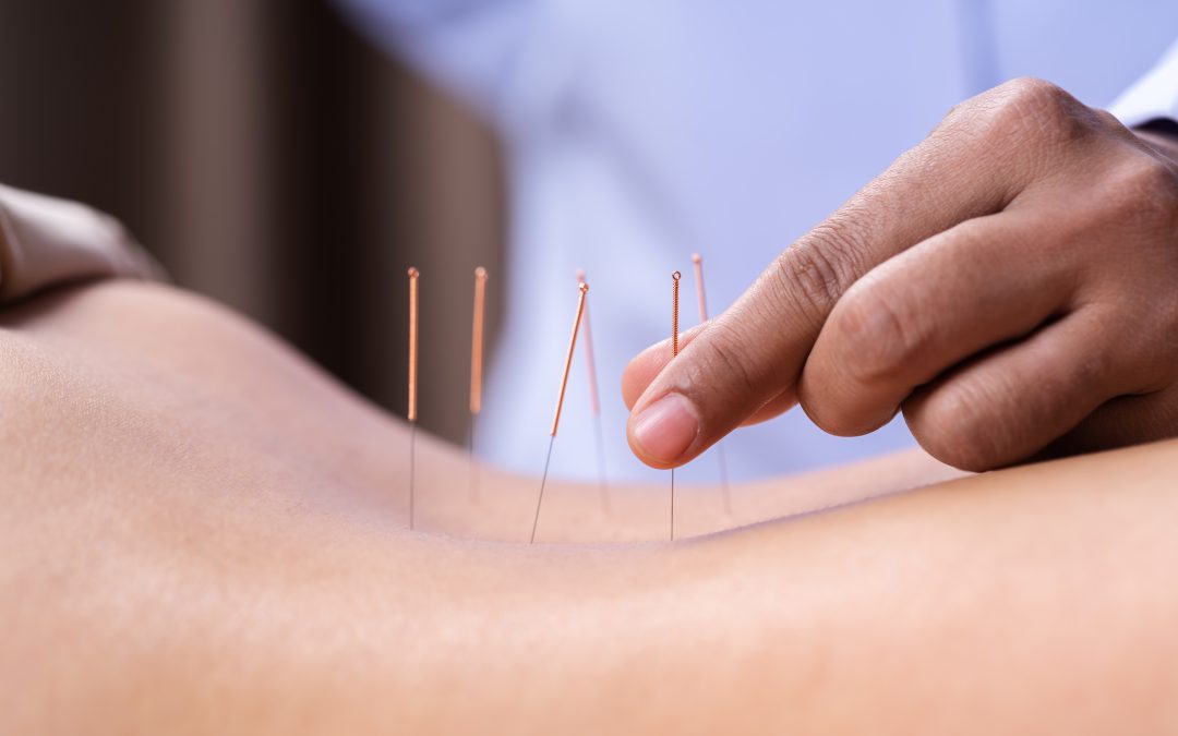 Beneficios de la acupuntura para combatir la obesidad
