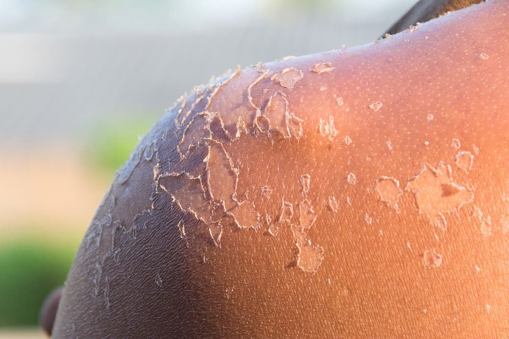 ¿Cómo puedes evitar pelarte después de tomar el sol? Aquí tienes la respuesta