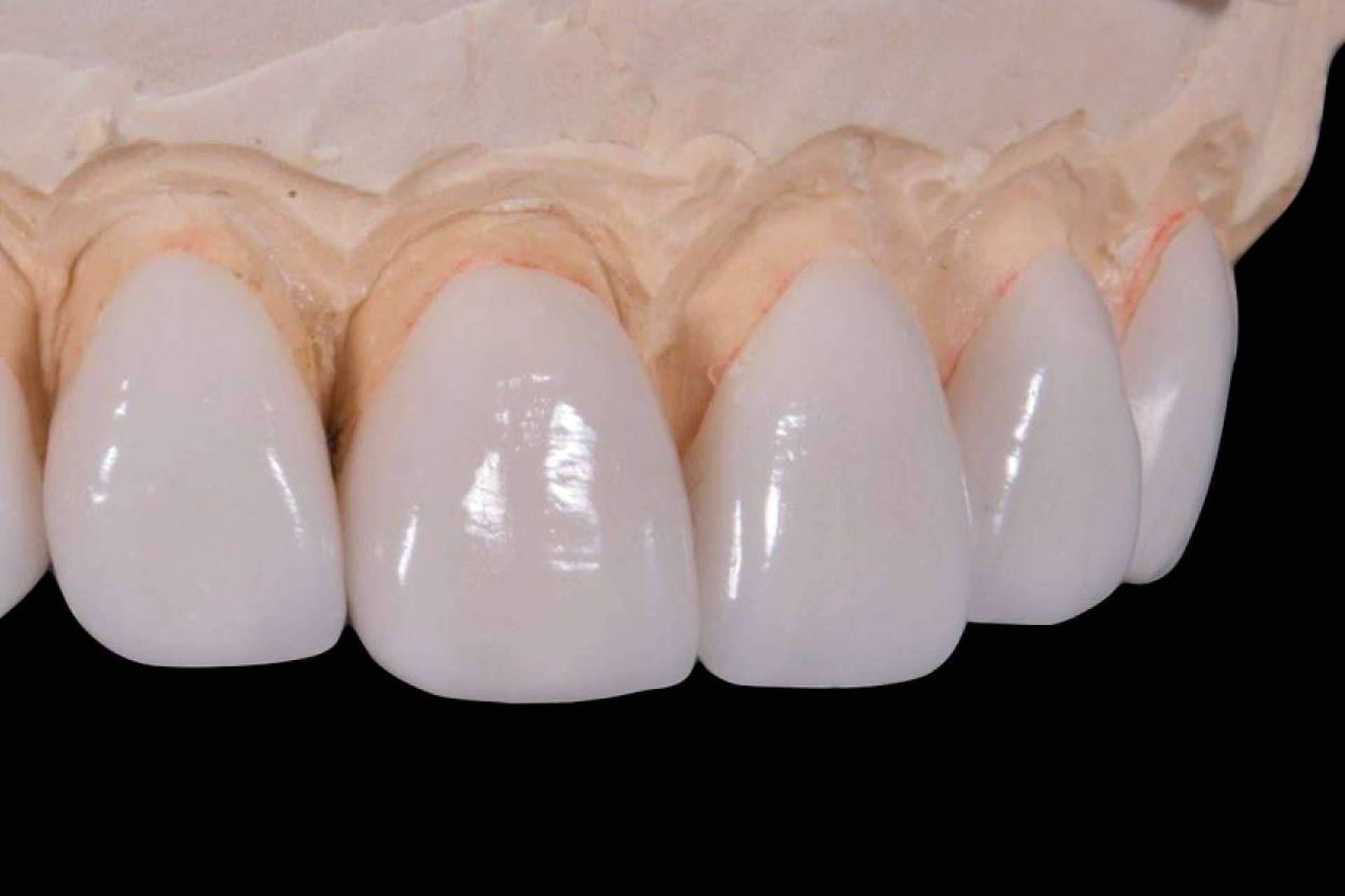 ¿Por qué las carillas estéticas en porcelana y composite son unas de las más populares?, por Clínica Calvo de Mora