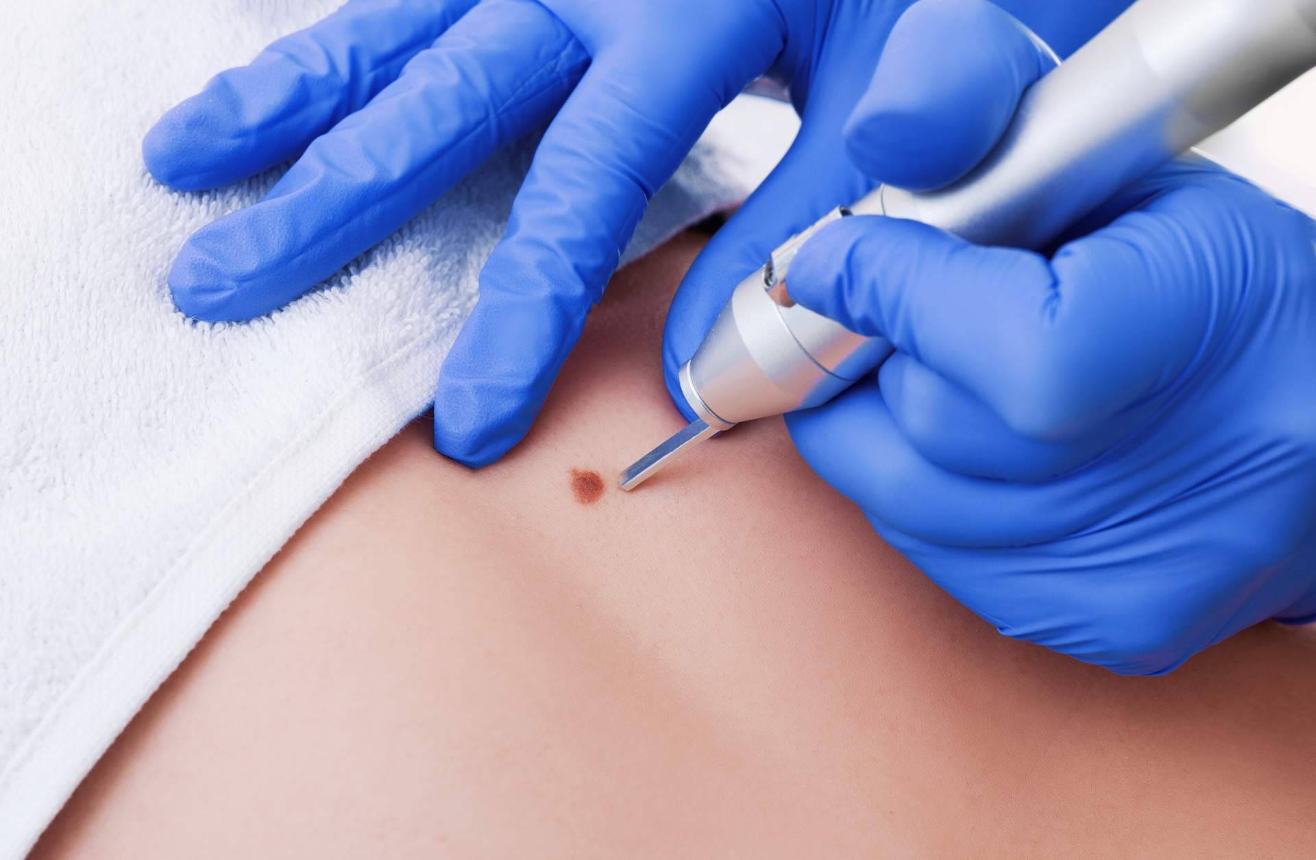 Eliminación de lunares y verrugas con los tratamientos más innovadores que ofrece Centro Estética El Pilar