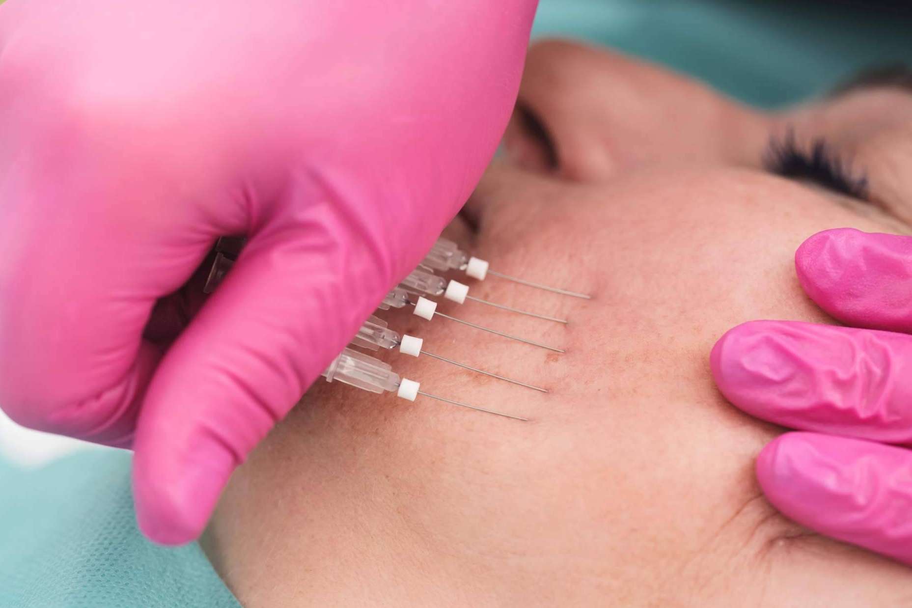 Cursos de especialización para médicos que se dedican a la estética, de la mano de Dermasthetic