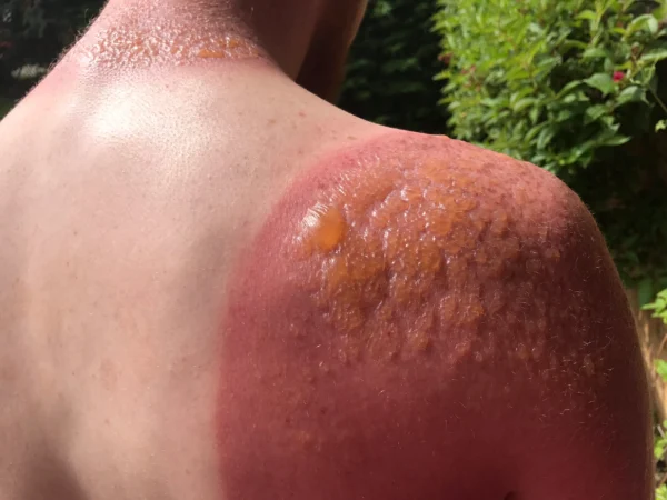 sunburn2 Merca2.es