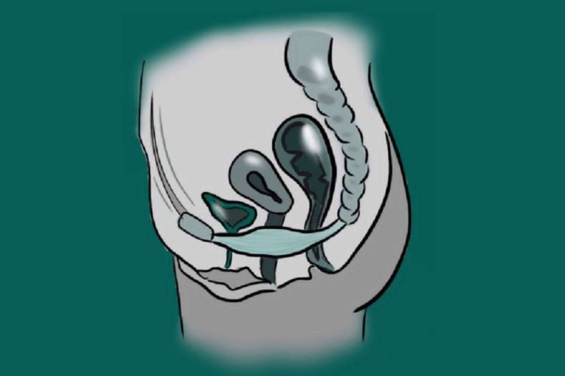 El Dr. Nelson Díez explica qué es un prolapso genital