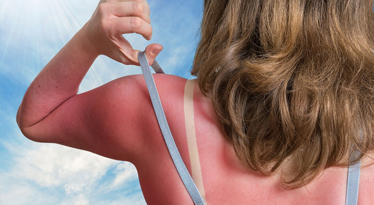 Si te has quemado al sol sigue estos consejos para curarte más rápido 1 Merca2.es quemaduras sol lasalud Merca2.es
