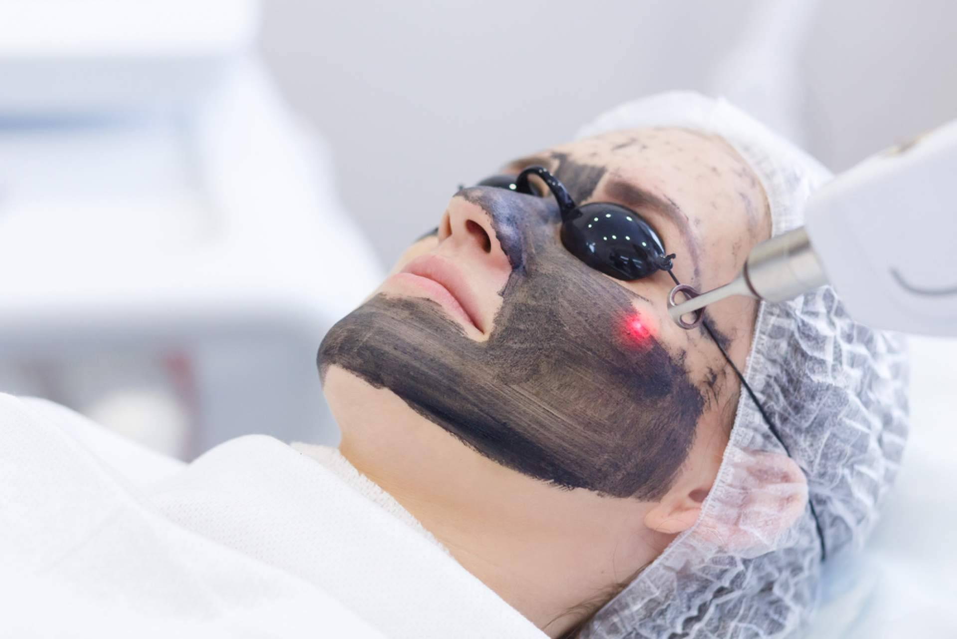 Las ventajas del carbon peel, con Crina Rus Beauty Center