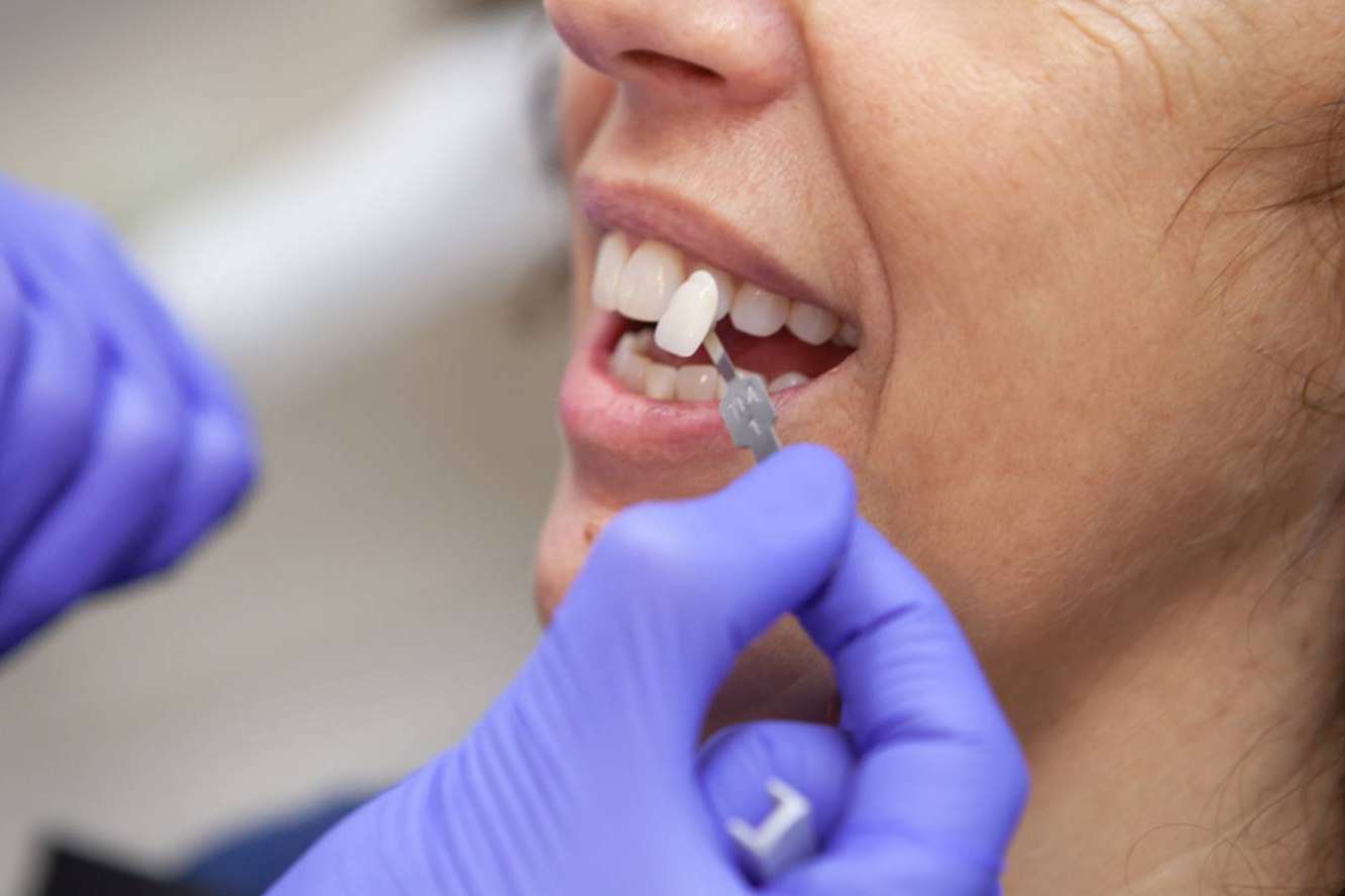 CLÍNICA CRISTINA VIYUELA + CO se especializa en la aplicación de carillas dentales