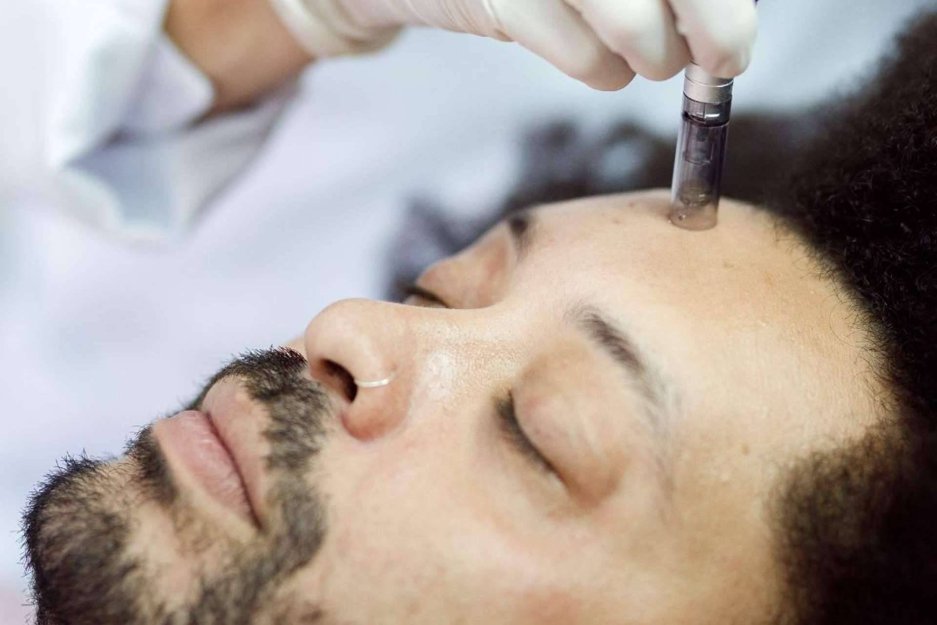 Información sobre el microneedling facial y capilar, con Malecare
