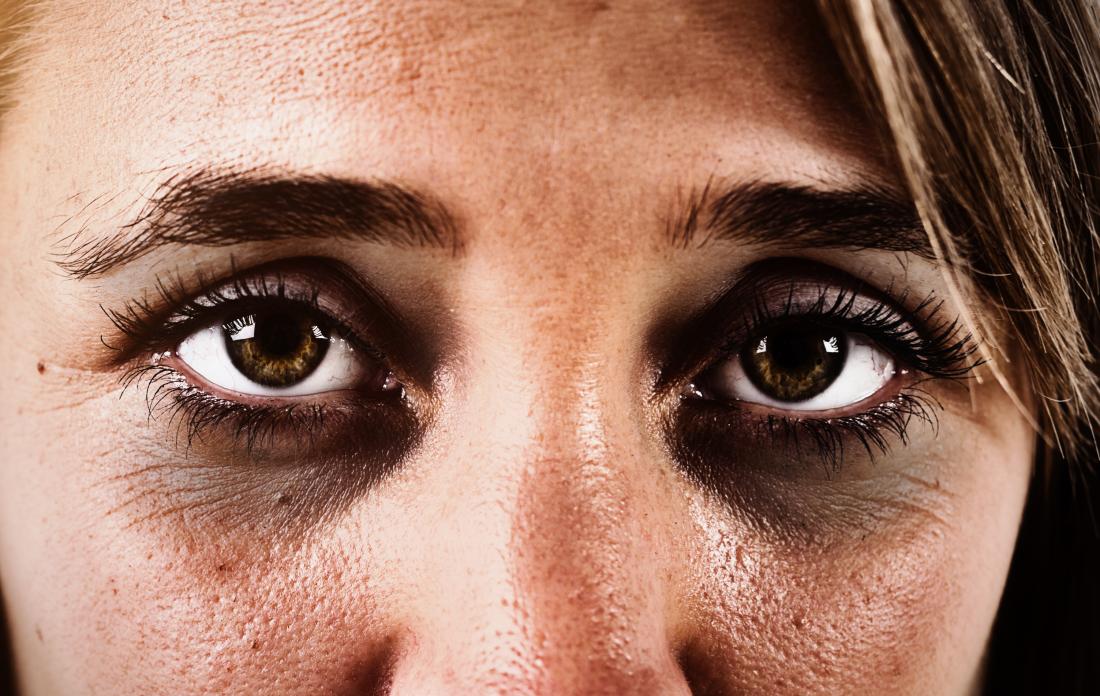 ¿Por qué salen las ojeras? Te explicamos cómo acabar con ellas