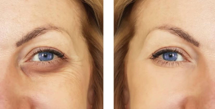 Pero, existen métodos para tratar las ojeras