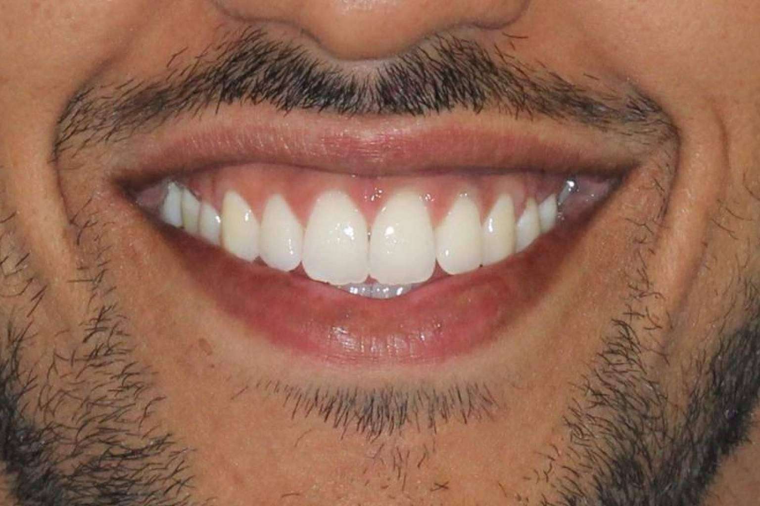 Los servicios de blanqueamientos dentales de la Clínica Zahara