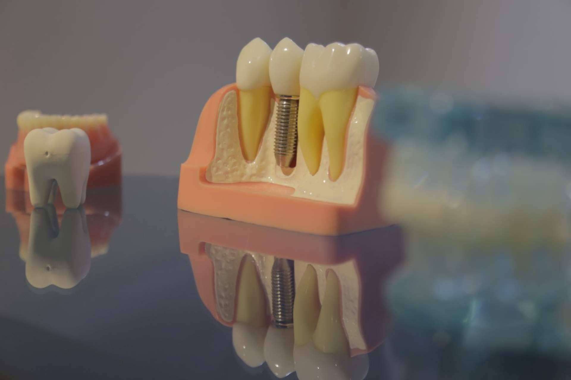 Los implantes dentales en Mexicali son una excelente opción más económica que en Estados Unidos
