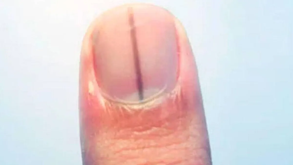 ¿Qué son y por qué salen esas ‘rayas’ en las uñas?