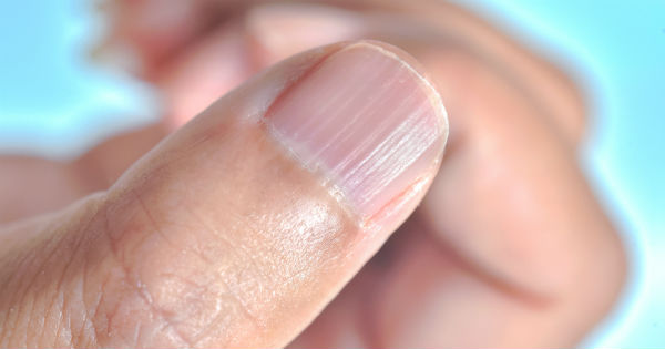La causa de las rayas en las uñas es múltiple