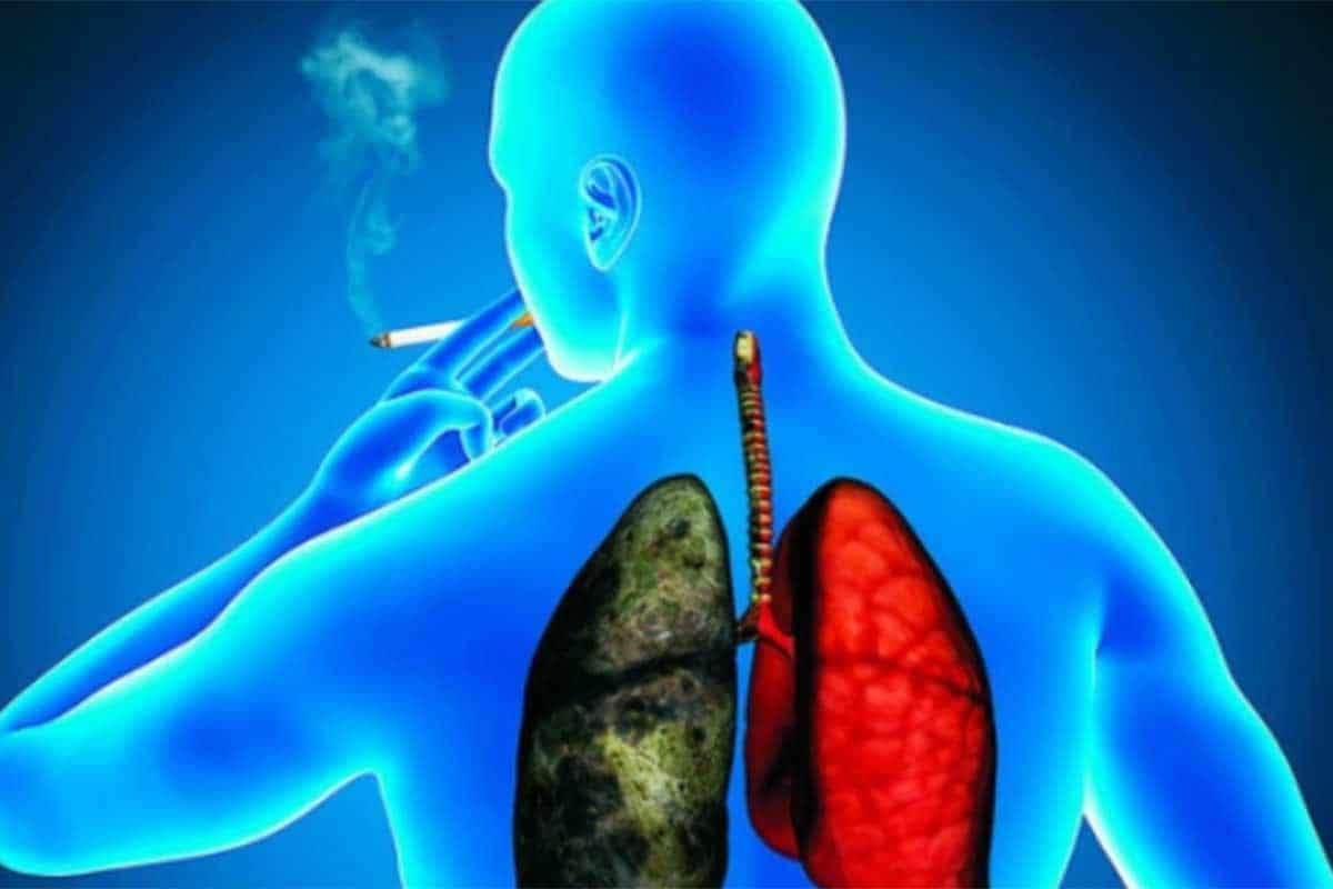Mención de los tratamientos reconocidos para el cáncer de pulmón