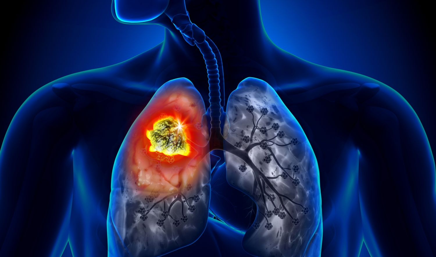 Beneficios de la medicina tradicional para el cáncer de pulmón