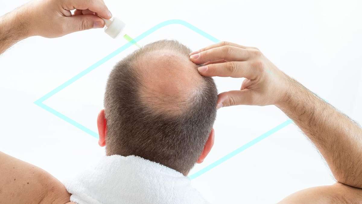 El Minoxidil es el medicamento de moda para evitar la caída del pelo, pero ojo a sus peligrosos efectos secundarios