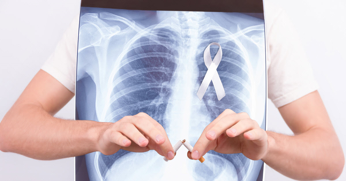 Iniciación de los síntomas del cáncer de pulmón