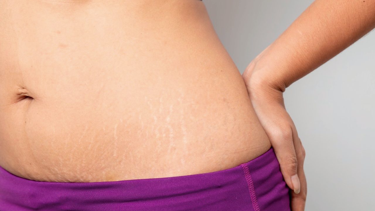 Estos son los mejores métodos para quitarte las feas estrías, ya seas hombre o mujer