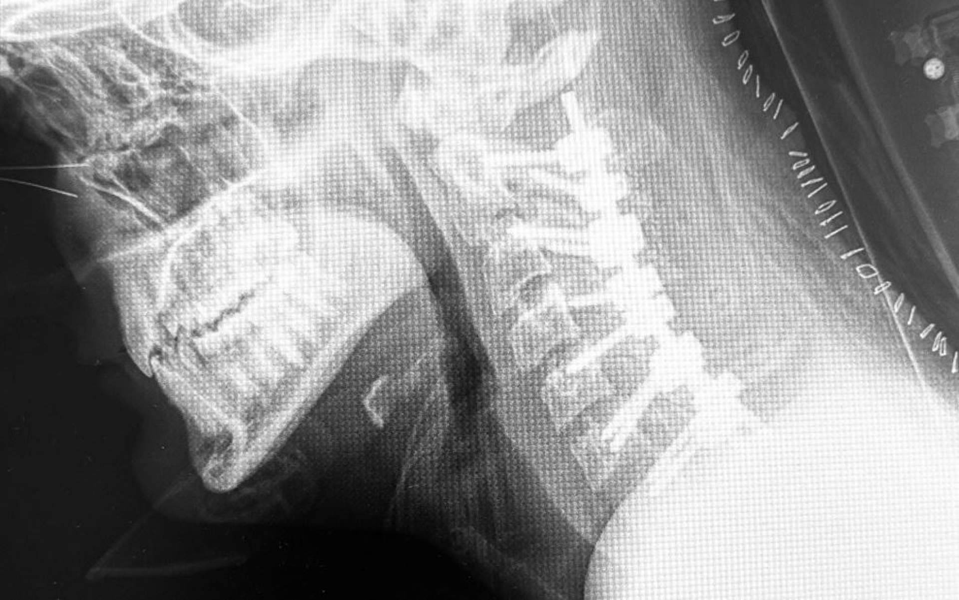 Cifosis post-laminectomía cervical, por el Dr. Botella-Asunción