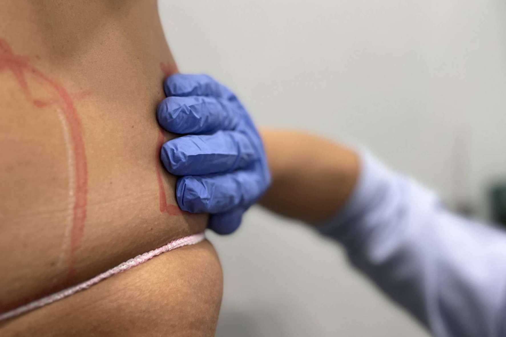 Reducir grasa localizada en 360Clinics con el revolucionario tratamiento Método Láserfit Medical