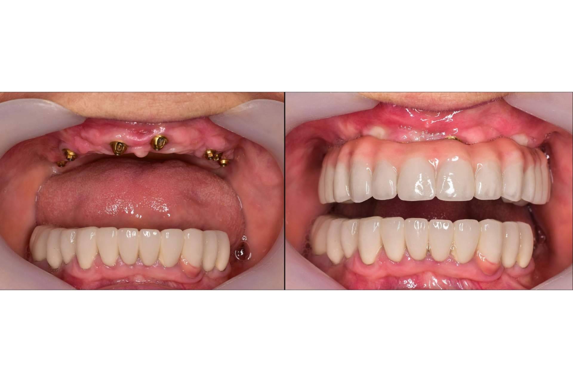 Las ventajas de un implante dental en DeltaDent