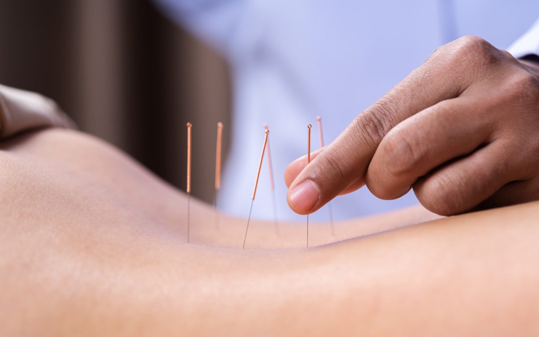 El poder de la acupuntura en el alivio del dolor y la relajación