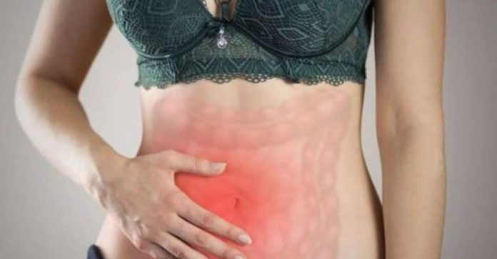 COLITIS ULCEROSA