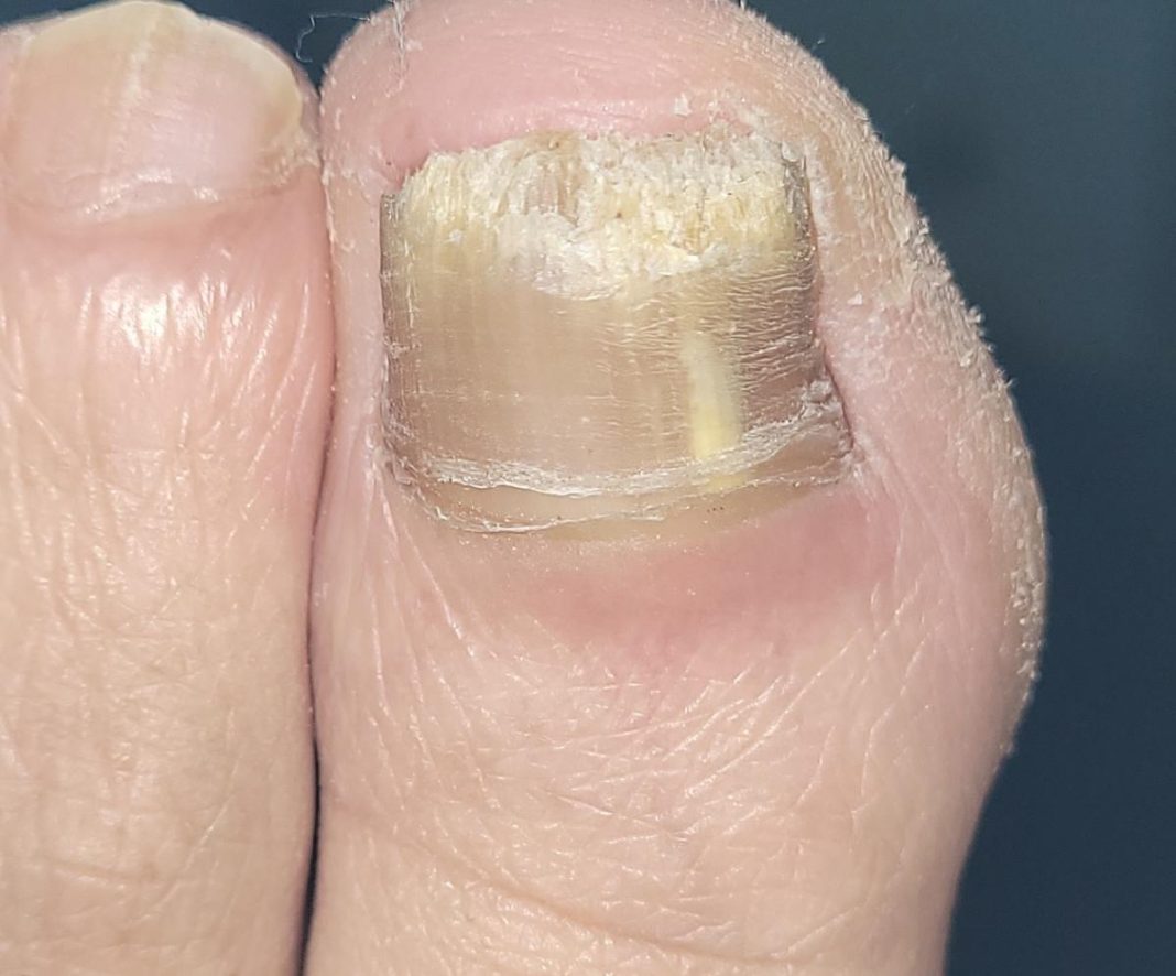 Este es el mejor método para librarte de los hongos de las uñas