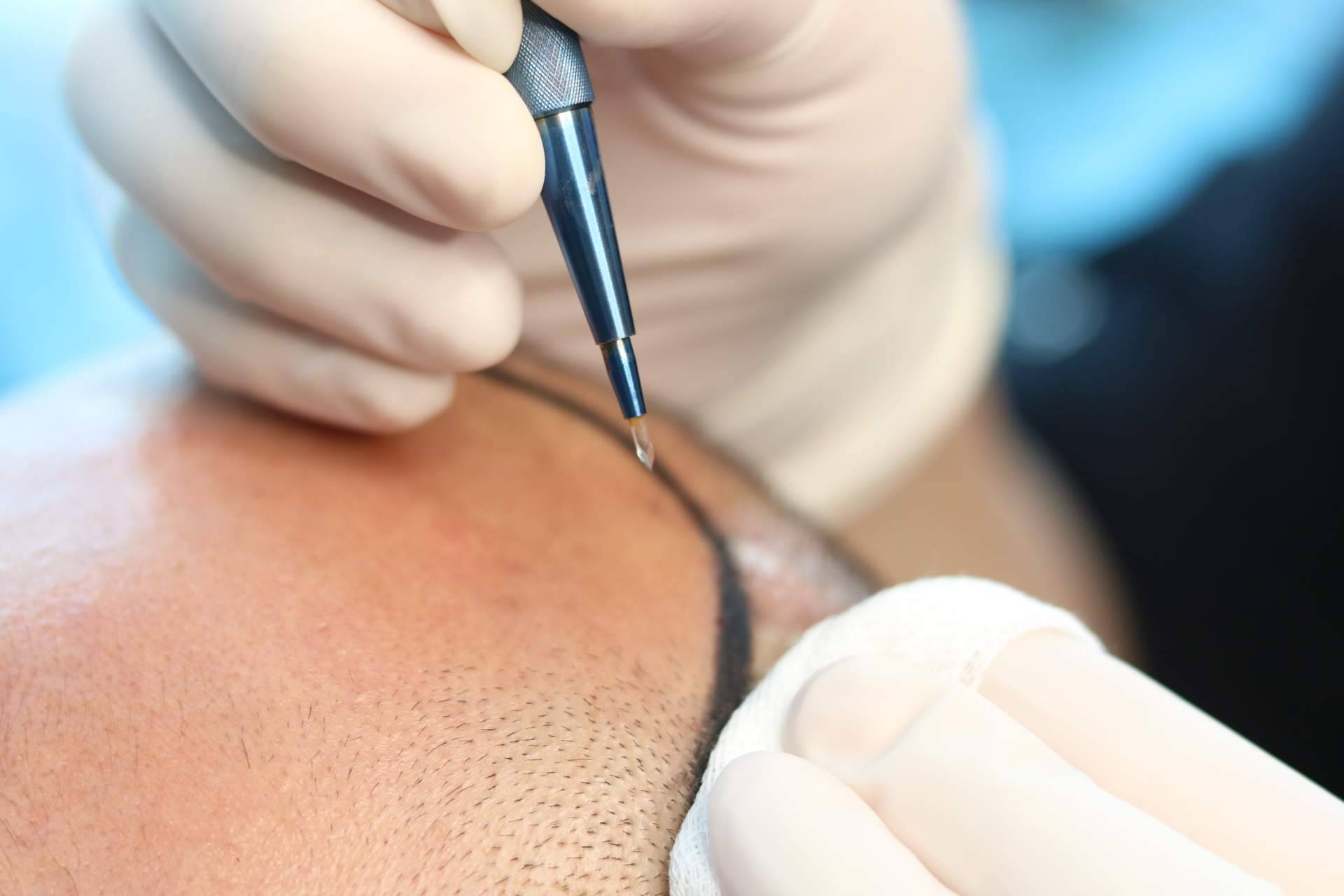FUE Zafiro, una técnica de trasplante capilar masculino disponible en Capilar Innovation Clinic