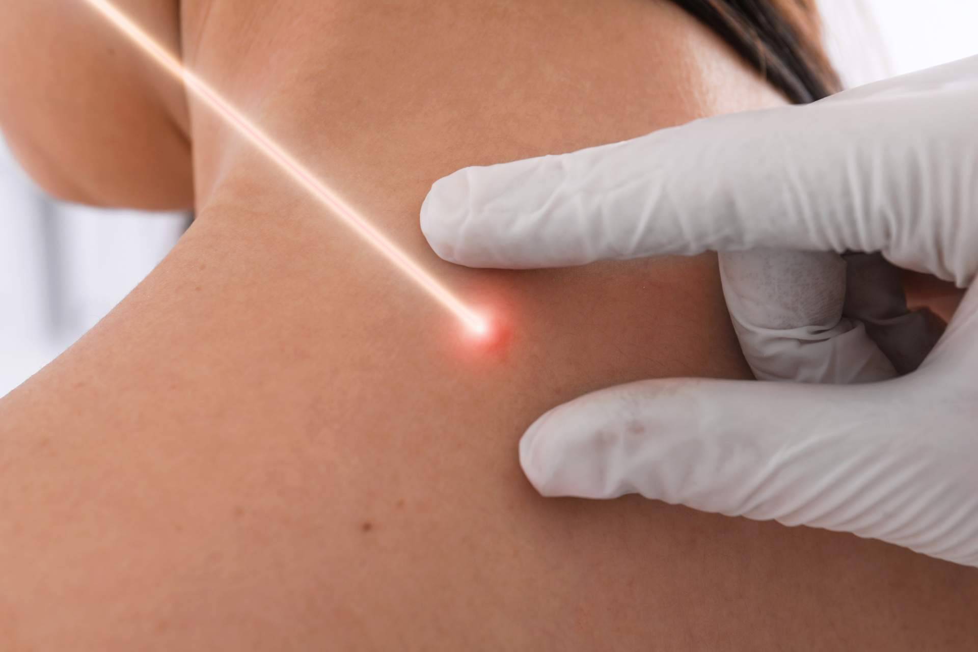 Centro Estética El Pilar permite eliminar manchas en la piel con láser a través de sus servicios