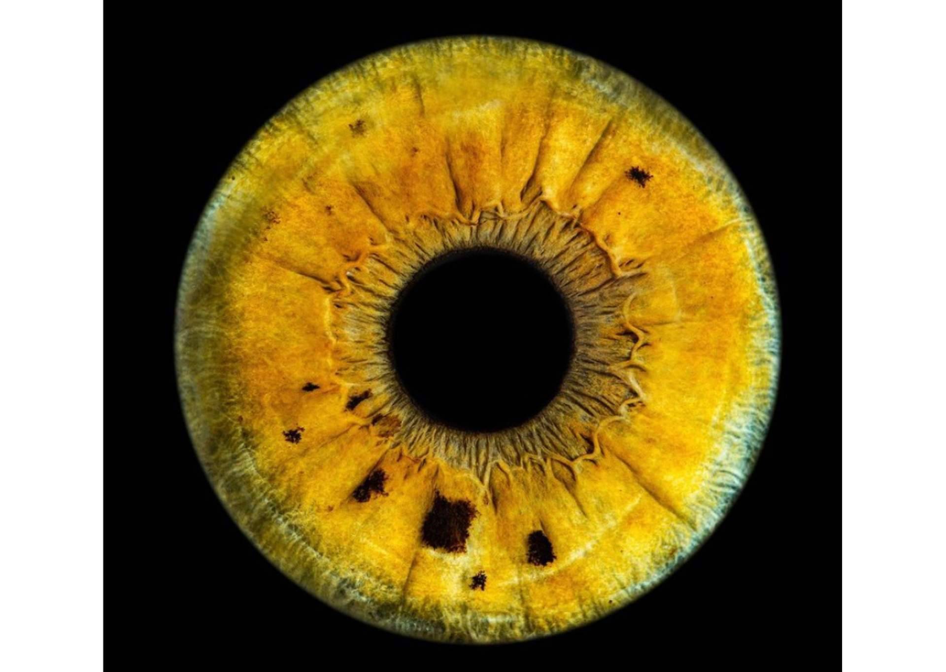 Las enfermedades metabólicas pueden cambiar el color de los ojos, una advertencia de la clínica Eyecos