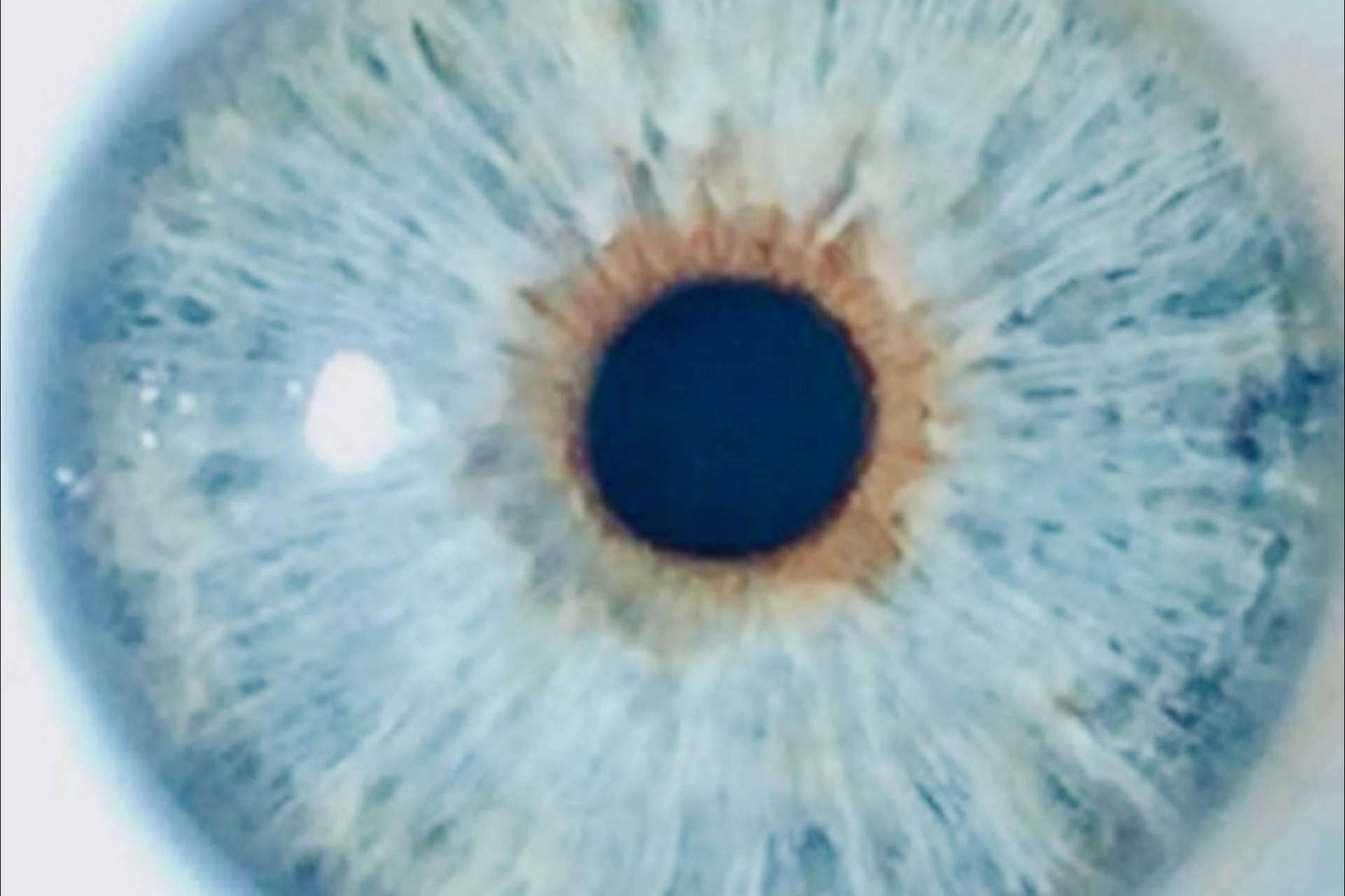 El riesgo mínimo de glaucoma crónico después de la iridoplastia láser, demostrado por Clínica Eyecos