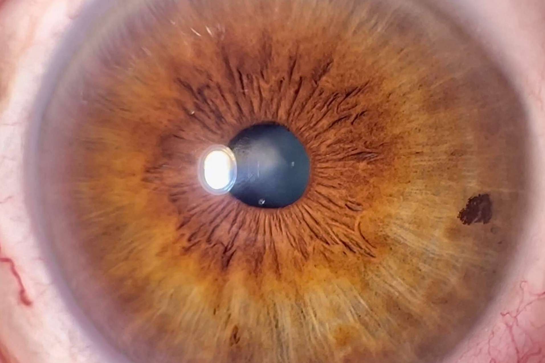¿Cómo tomar fotos del iris HD con un smartphone? Clínica Eyecos