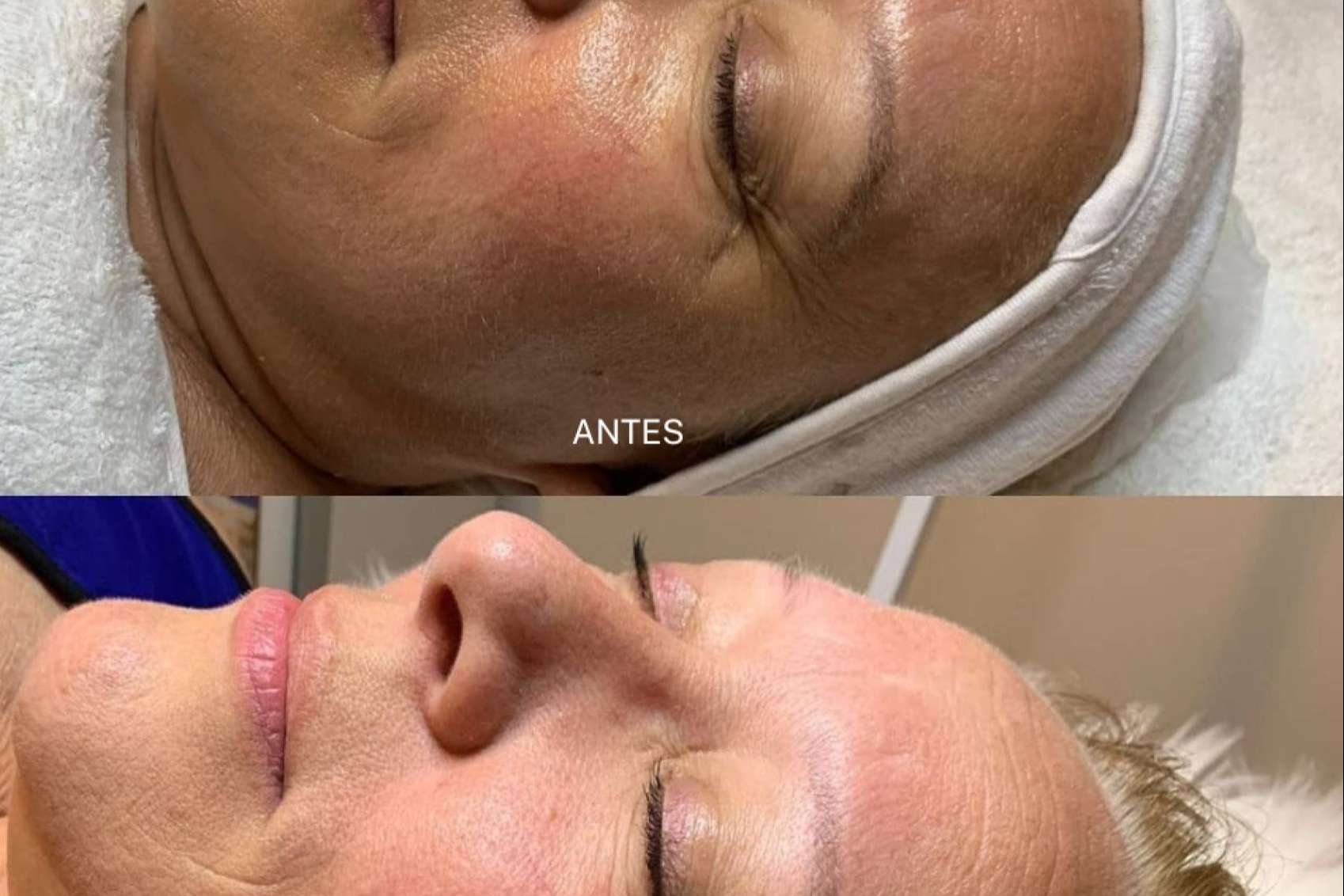 Uno de los mejores peelings de alta intensidad