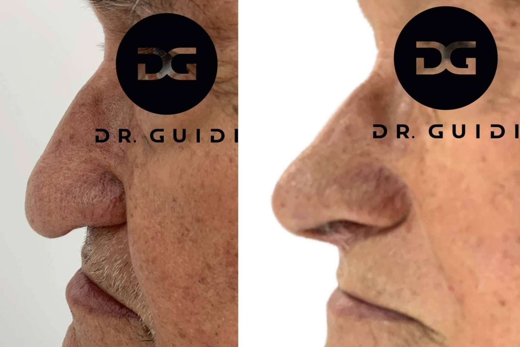 La clínica del Dr. Guidi ofrece tratamientos de rinomodelación