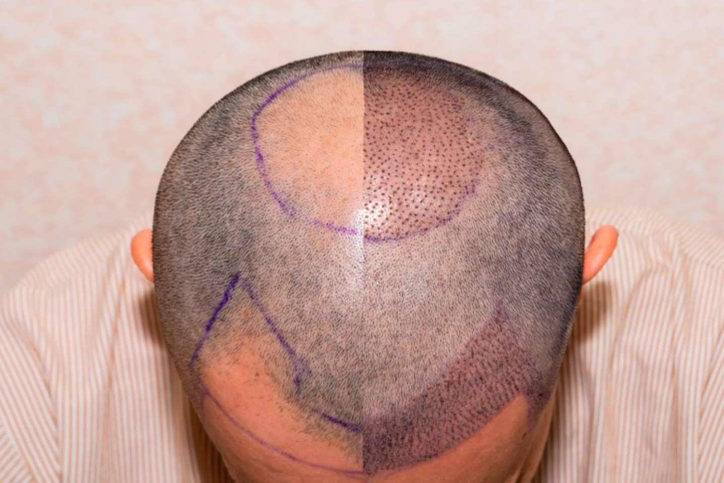 MC360 dispone de expertos en injertos de pelo